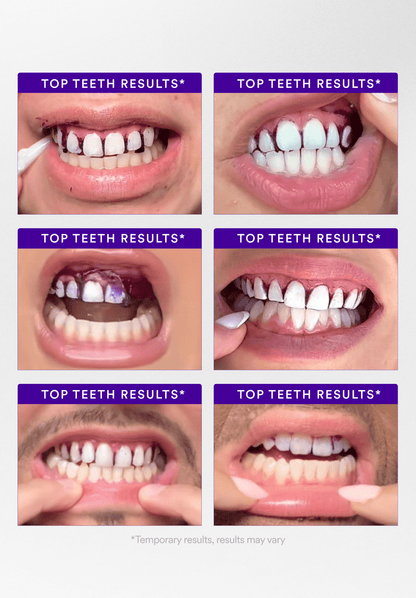 Teeth Whitening Strips with Color Correction – Instant Brightening & Stain Removal
