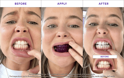 Teeth Whitening Strips with Color Correction – Instant Brightening & Stain Removal